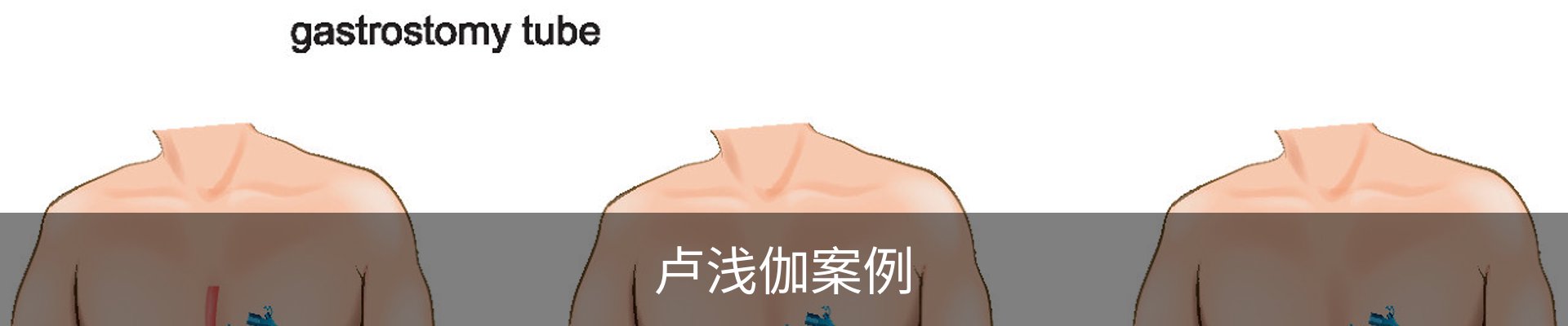 卢浅伽案例